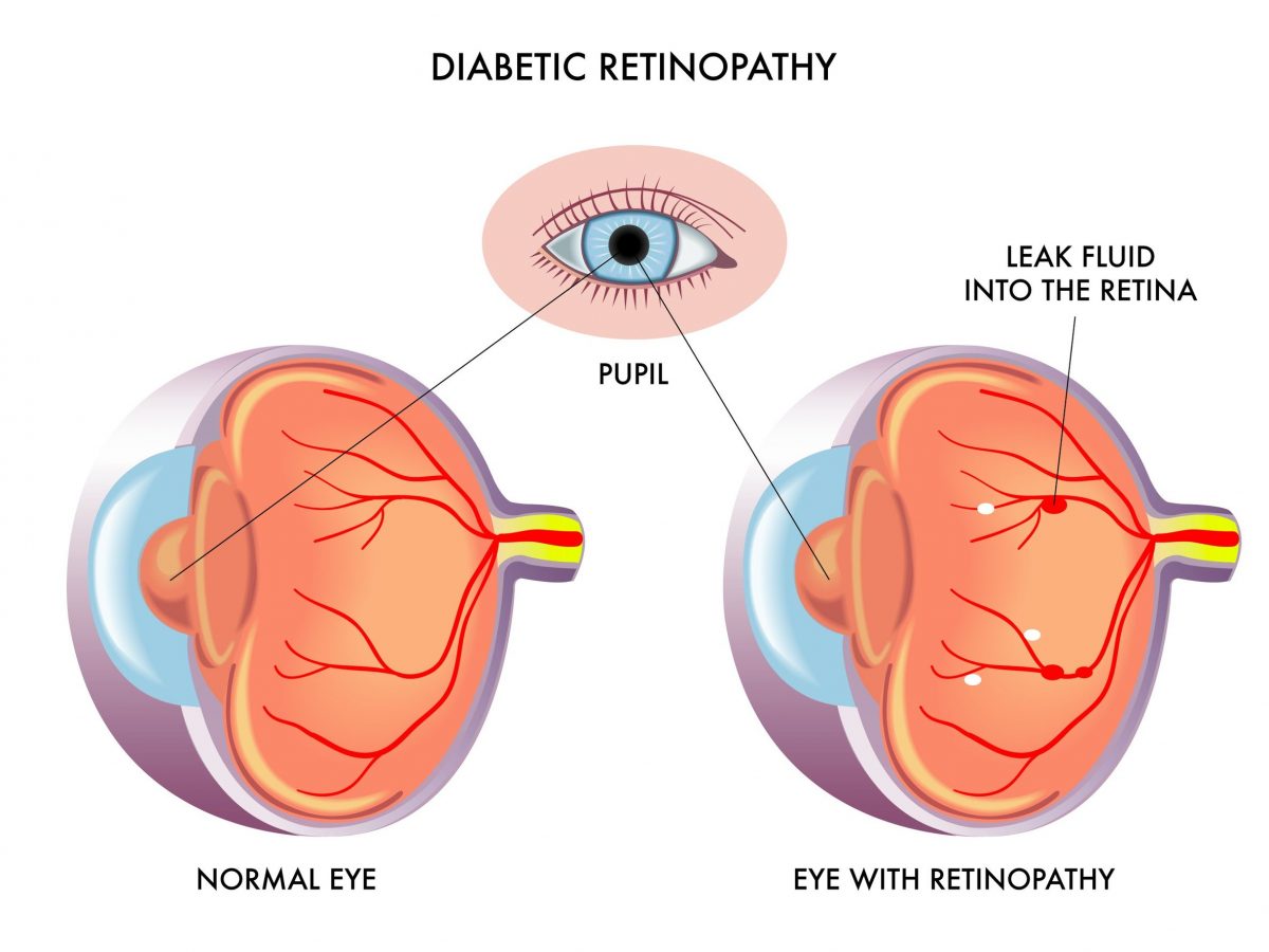 Diabetic Retinopathy - LASIKSurgeons.com