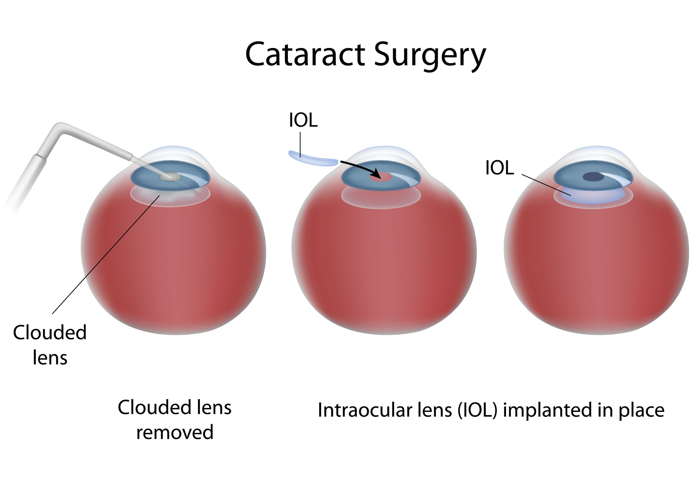 Traditional Cataract Surgery Procedure