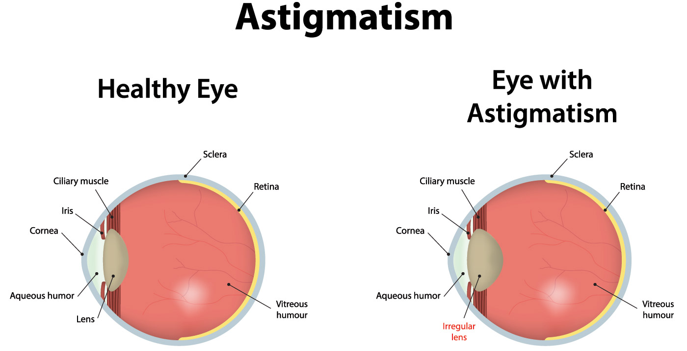 Astigmatism Astigmatism